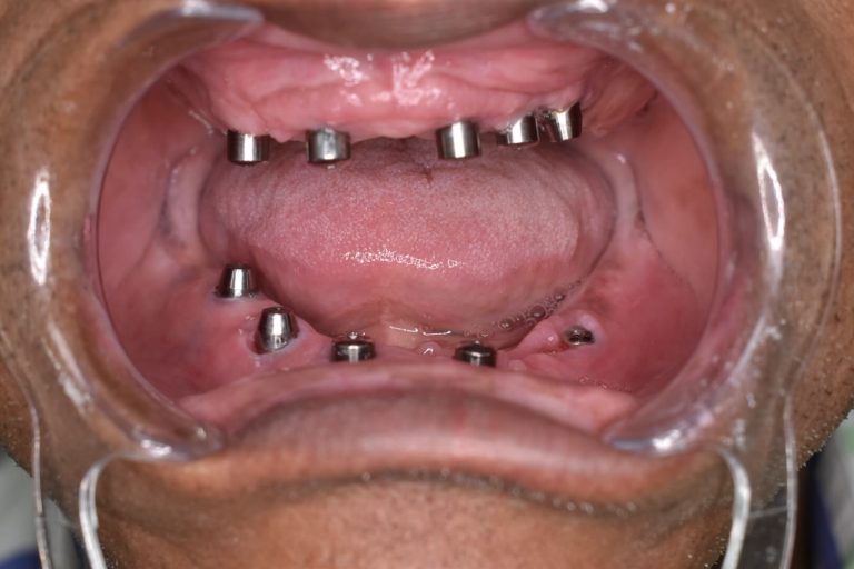 Rehabilitación con Implantes